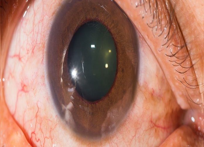 glaucoma